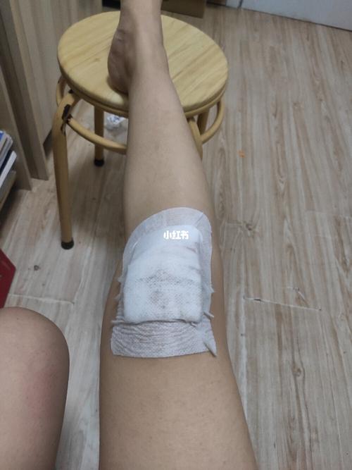 今天腿真的磕伤了,我该难过还是开心_本命年_学习_工作_受伤_医疗健康