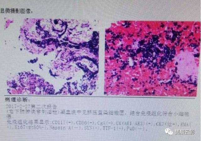 病理诊断:小细胞癌