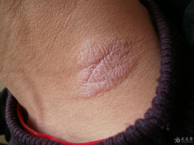 典型病例分享:神经性皮炎.