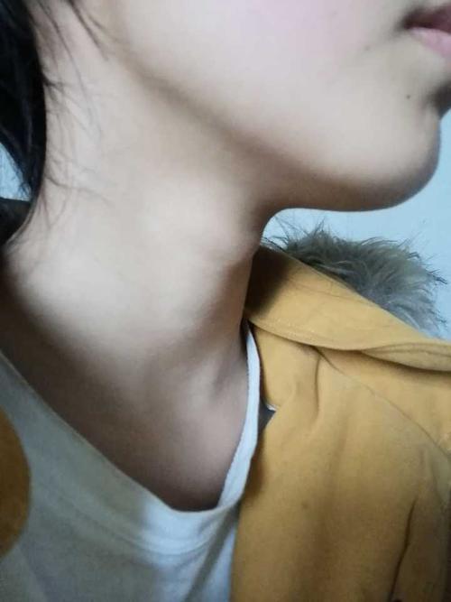 女生长喉结怎么办?是因为太瘦了还是激素分泌不正常?