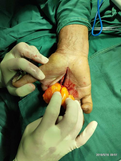 手部巨大脂肪瘤一例!(副本)