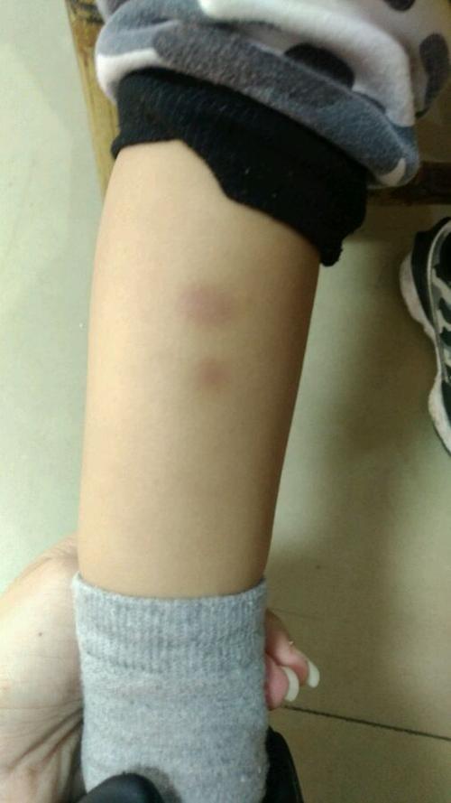 小孩轻微紫癜症状图片