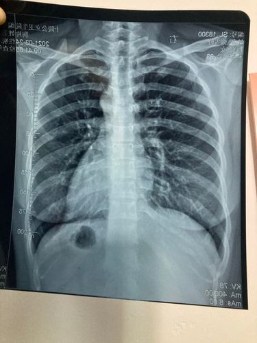 最近右边肋骨时有时无的各种不适