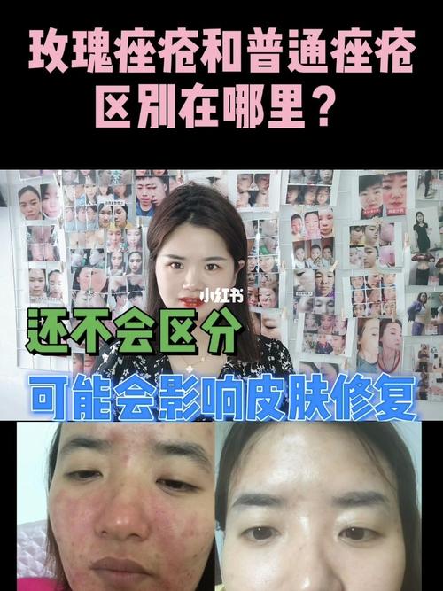 玫瑰痤疮和普通痤疮的区别在哪里_玫瑰痤疮_痤疮_修复