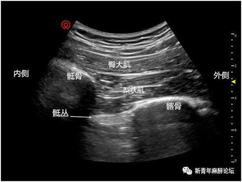 对应超声图像(超声探头向内下方移动后)