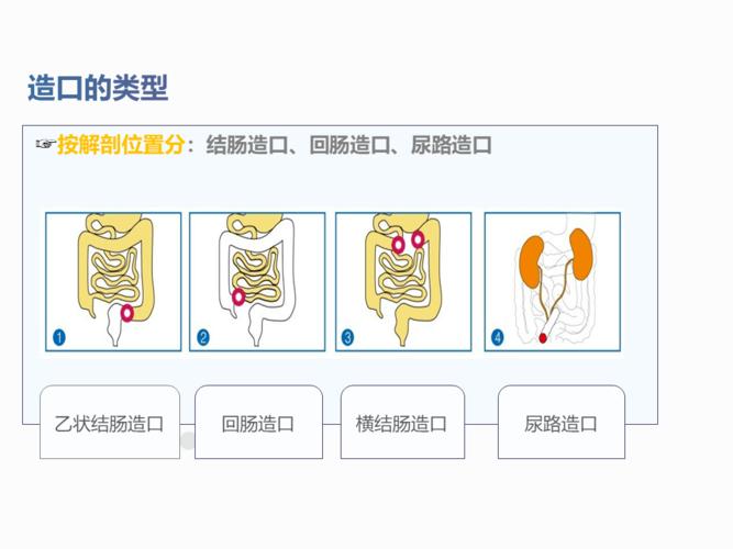 【ppt】一例结肠癌术后肠造口缺血坏死护理查房