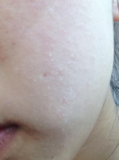 最近脸上老起皮怎么回事