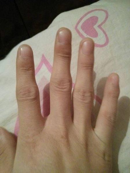 3,还有就是骨质增生,这种是最常见的手指关节肿胀疼痛的原因.由