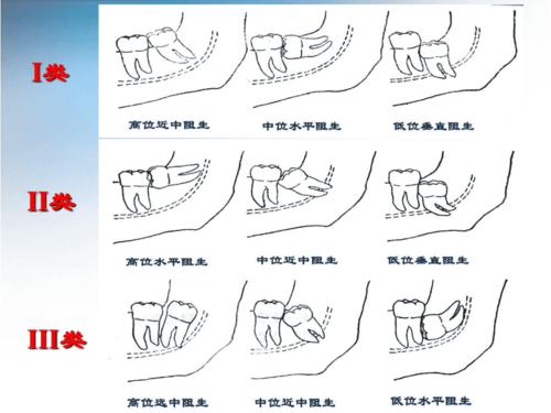 第四节丁宇翔阻生牙拔除术 ppt