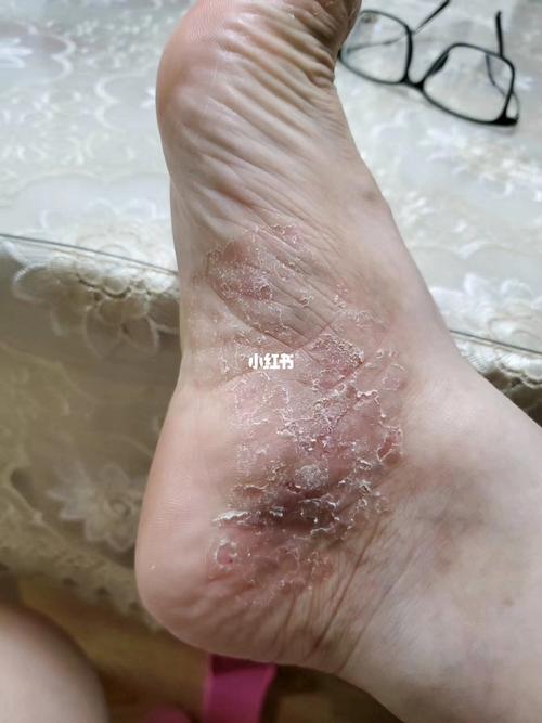 脚部湿疹图例七十一_脚部_湿疹_医疗健康_医疗健康其他