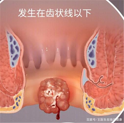 直肠和肛管的交界线称为齿状线,肛门癌便是发生在齿状线下方,以肛门