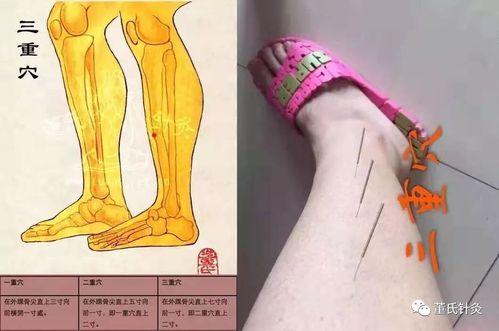 【董氏针灸】学员病案分享之乳腺疾病处方穴