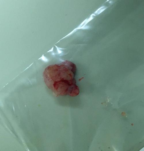 患者王某20余天前因"反复咳嗽,咳痰2月余"我院确诊为肺癌,然而疾病