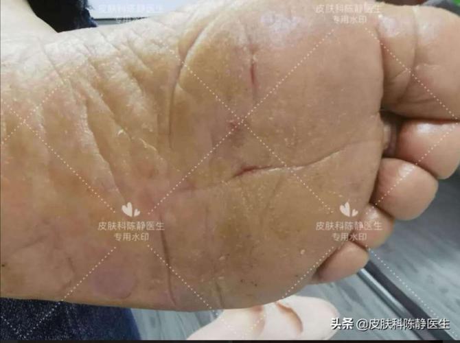 手掌,足底瘙痒,干裂,脱皮——手足部特应性皮炎患者的问诊小记