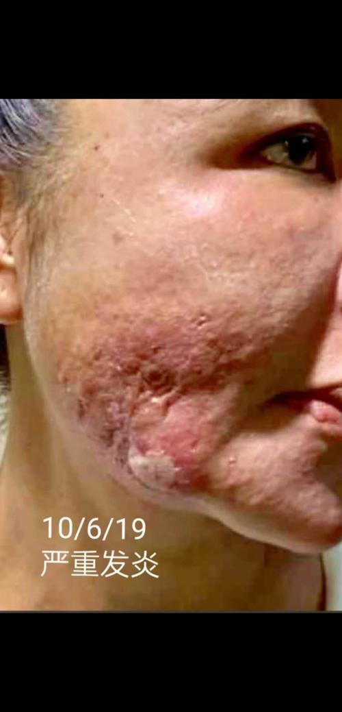 音视频moon老师分享微整形失败脸部皮肤三年溃烂用美极客产品恢复正常