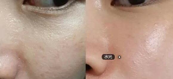 水光针介绍原理价格