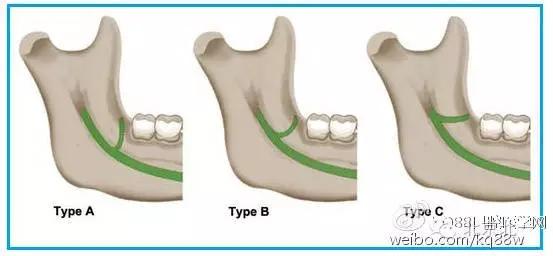 北一微创磨牙后区的隐形杀手下颌磨牙后管