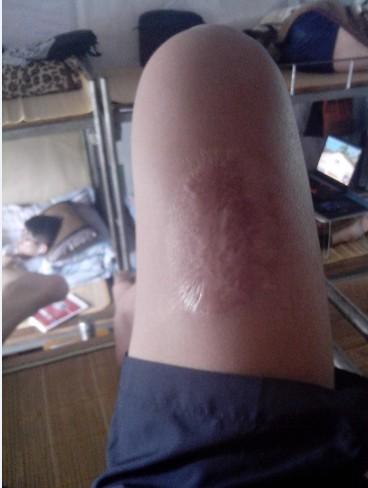 我手肘跟大腿上有这么大的伤疤,还能当兵吗?