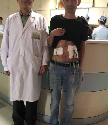 4楼摔下还活着的十二指肠破裂三造瘘结局