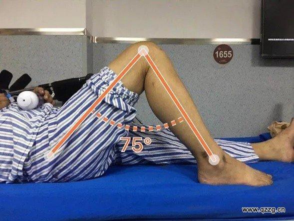 经过手术及康复锻炼,患者膝关节屈曲角度达105度,伸直角度达0度