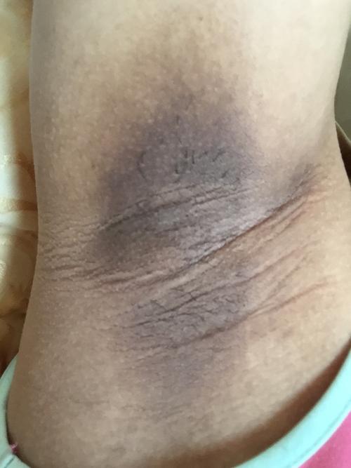 怀孕身体部位变黑