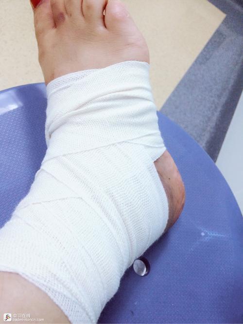 求问脚踝扭伤,恢复期一般要多久?