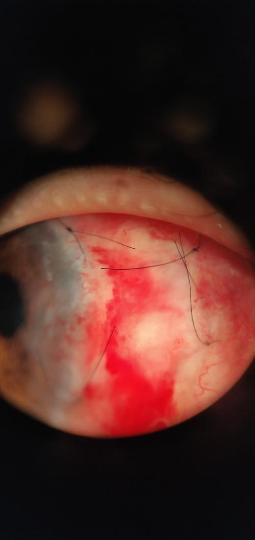 角膜缘干细胞移植术,复发率极低的翼状胬肉手术!