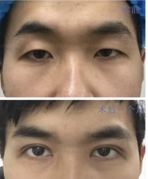 男生割双眼皮男生图片大全