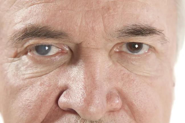 合肥普瑞眼科科普|白内障手术为什么要植入人工晶体?