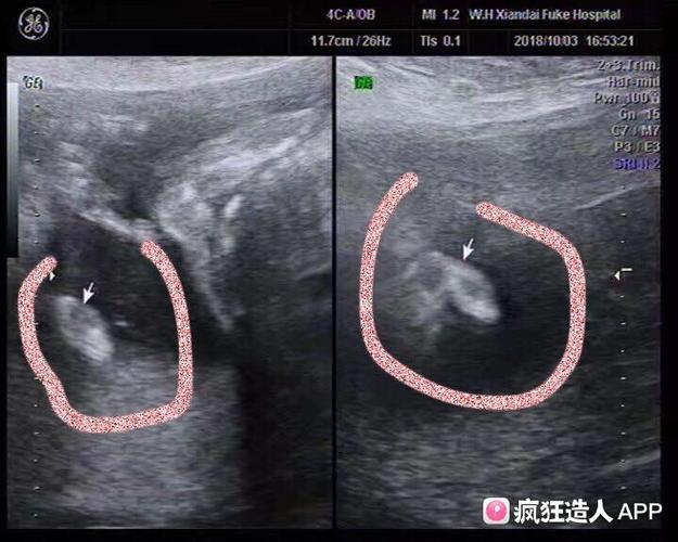 [试管婴儿]b超四维看见的是小j吗?