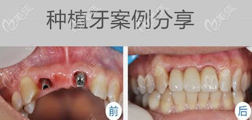 我上门牙连缺三颗在长沙铂菲特口腔做完登腾种植牙后吃啥都香了