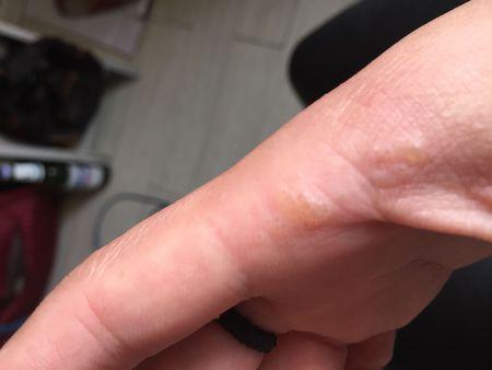 手上跟虎口之间起泡!有点痒?属于什么皮肤病呢?还是过敏症状?