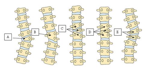          先天性脊柱侧凸畸形示意