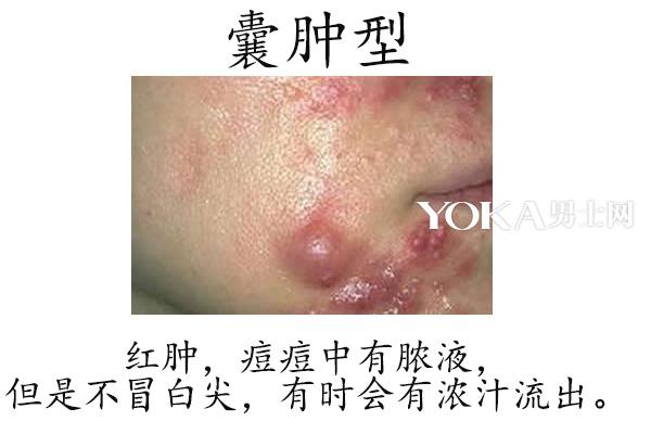 表现为炎性丘疹和黑头粉刺者称丘疹性痤疮