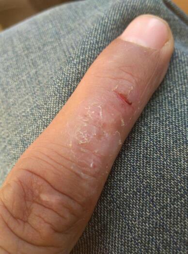 我手上有有种皮肤病,好多年了一直不好,症状是夏天发病冬天症状消失