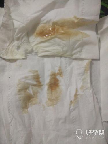 今年三月份也是突然胎停了一个,刚开始也是先流褐色分泌物