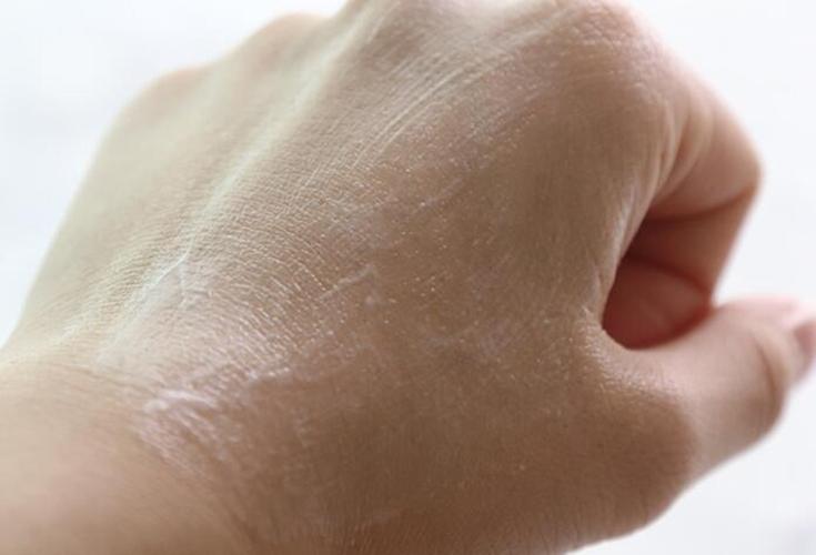 冬季肌肤干燥缺水_最需要温和的去角质产品