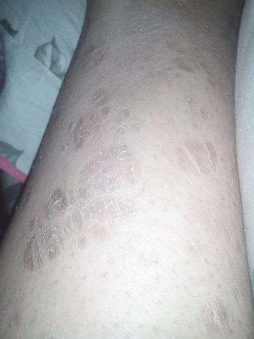 看一下这是什么皮肤病? 广告勿进!