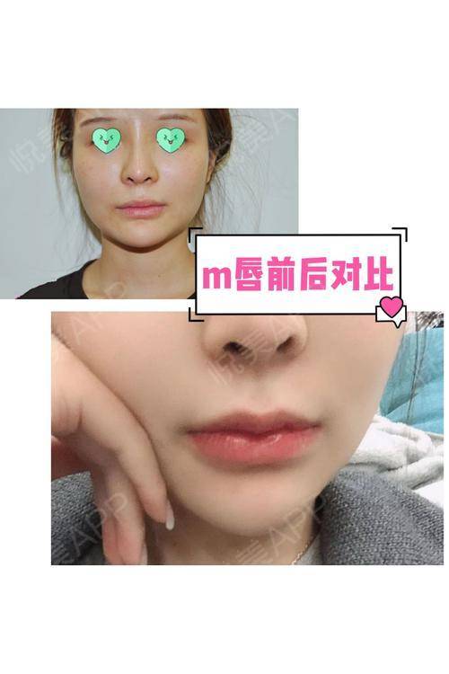 m唇花瓣唇案例分享