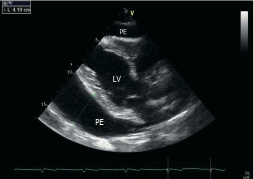 二维超声心动图:胸骨旁长轴切面显示大量环绕心包积液,舒张期为