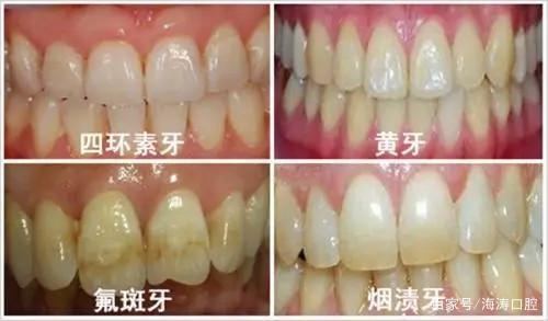 四环素牙怎样才能变白科普关于四环素牙的二三事