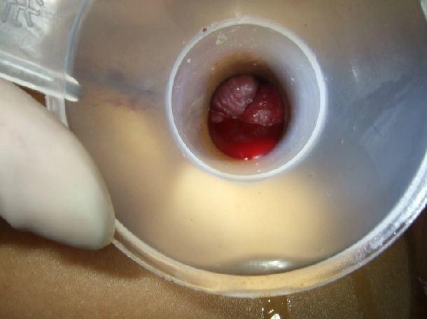 花季少女患痔疮后成功自愈一个小妙招轻松摆脱肉球亲测有效