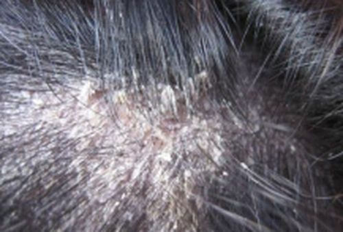 头部脂溢性皮炎应多久洗次头