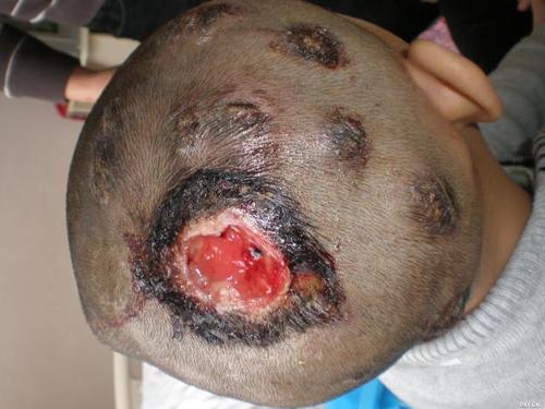 很不幸在基层医院切开了,切记脓癣禁忌切开排脓,否则该部位就是永久性