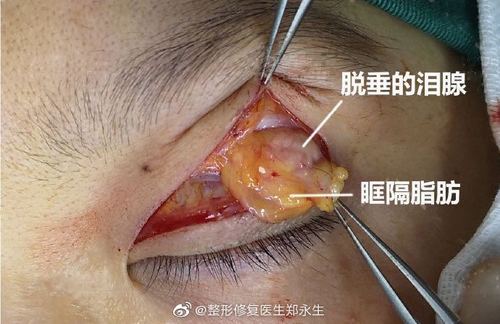 什么是泪腺脱垂