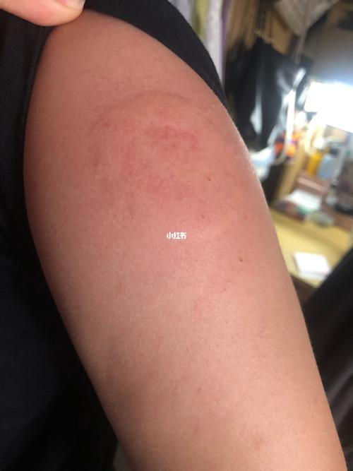 救救孩子吧,拉肚子拉一天,姨妈提前十天,打完第一针就有这样反应