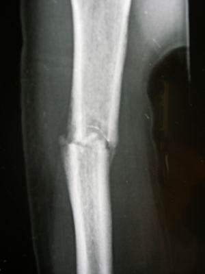 转载伤筋动骨一百天吗