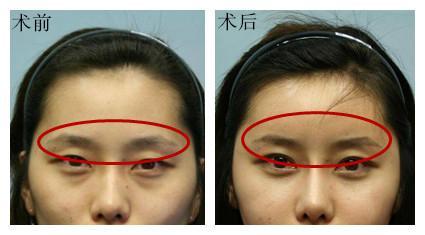 有一种手术叫"眉弓再造",就是采用硅胶等医用材料把不明显的眉骨垫高
