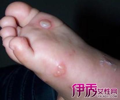 【图】宝宝脚上长透明水泡图是怎样的 小编教你有效的解决偏方