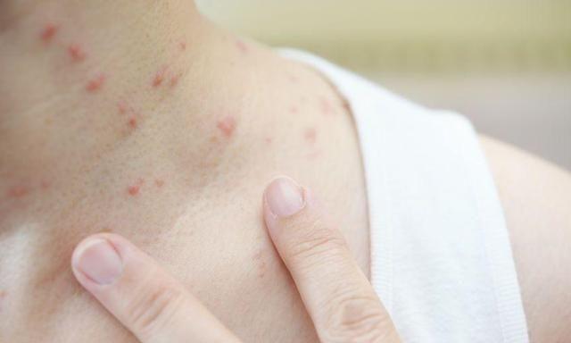 皮肤经常瘙痒,了解这几个症状,自我判断是不是得了"荨麻疹"
